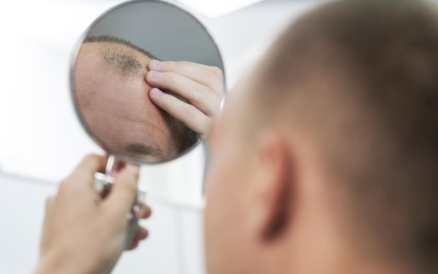Врач назвал главную причину, почему мужчины рано лысеют
