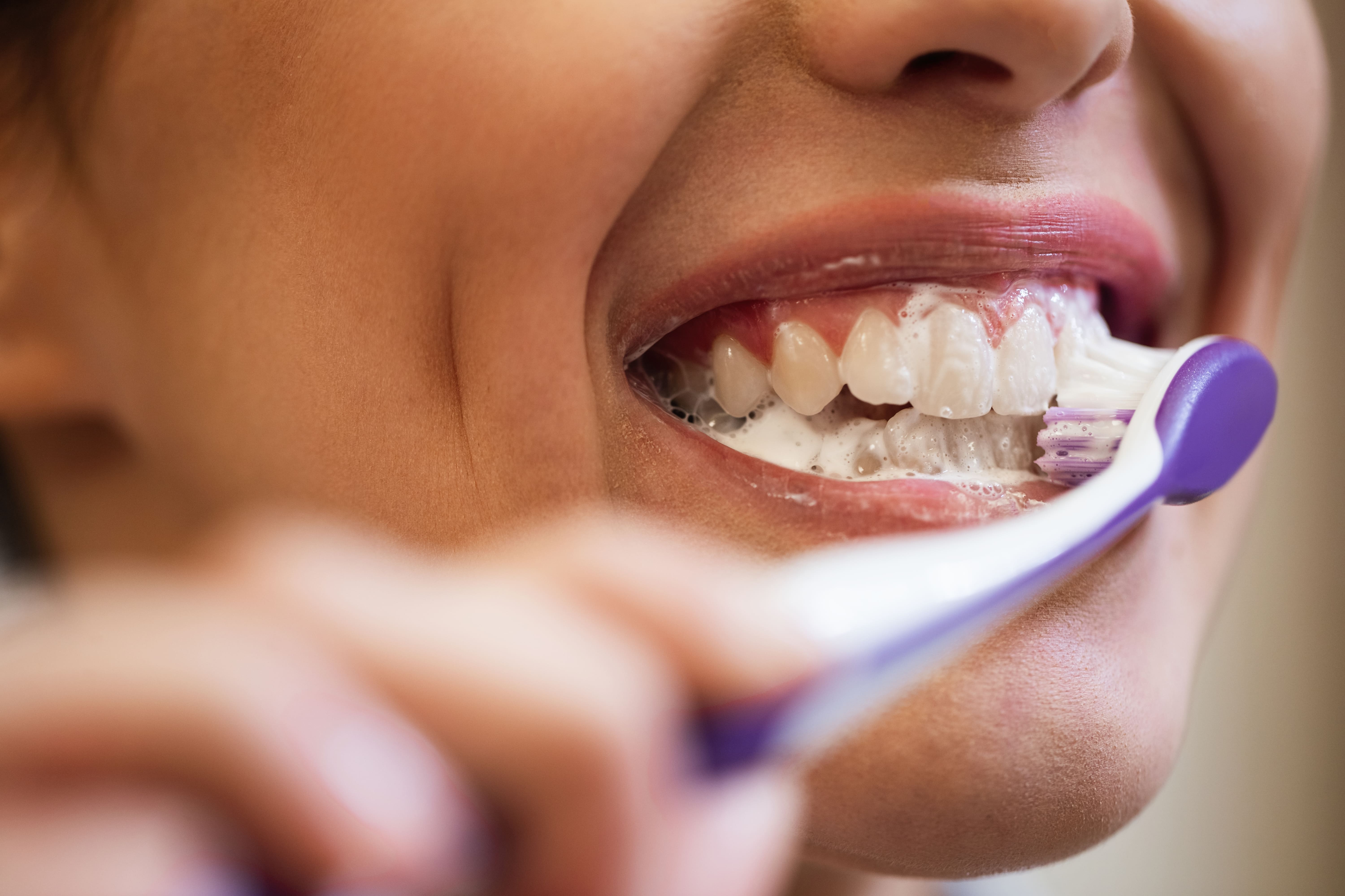Методы отбеливания зубов. Отбелить зубы в домашних условиях. Неудачное отбеливание зубов.
